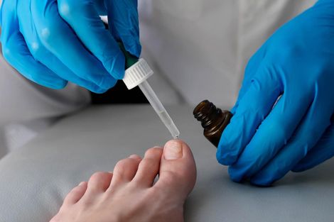 Persona aplicando líquido en una uña del pie con un gotero, usando guantes azules.