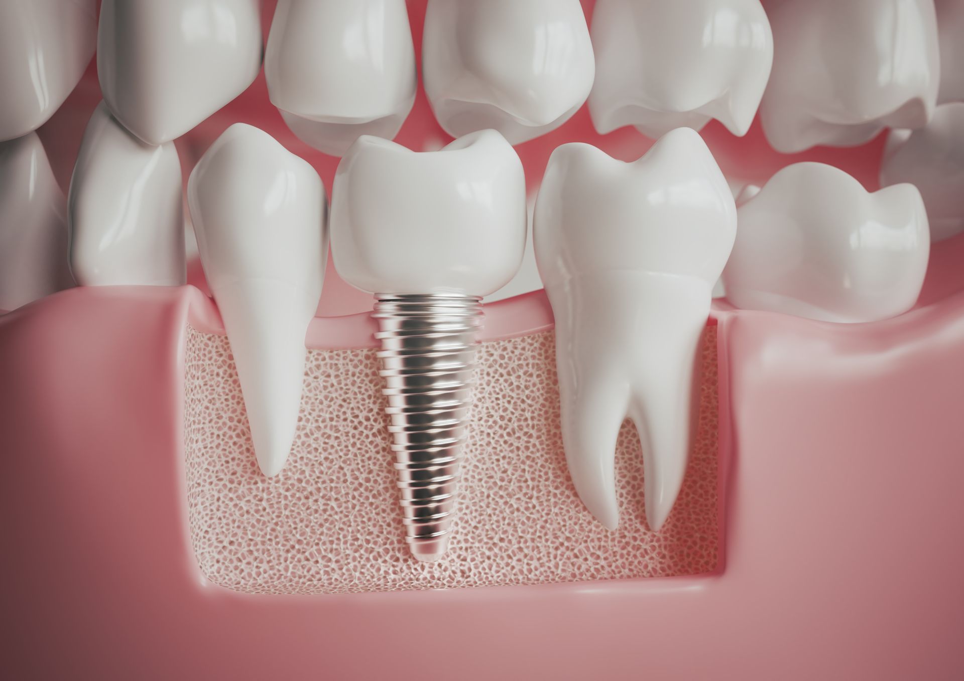 Ilustración dental en 3D que muestra un implante dental entre dientes naturales en encía rosada.