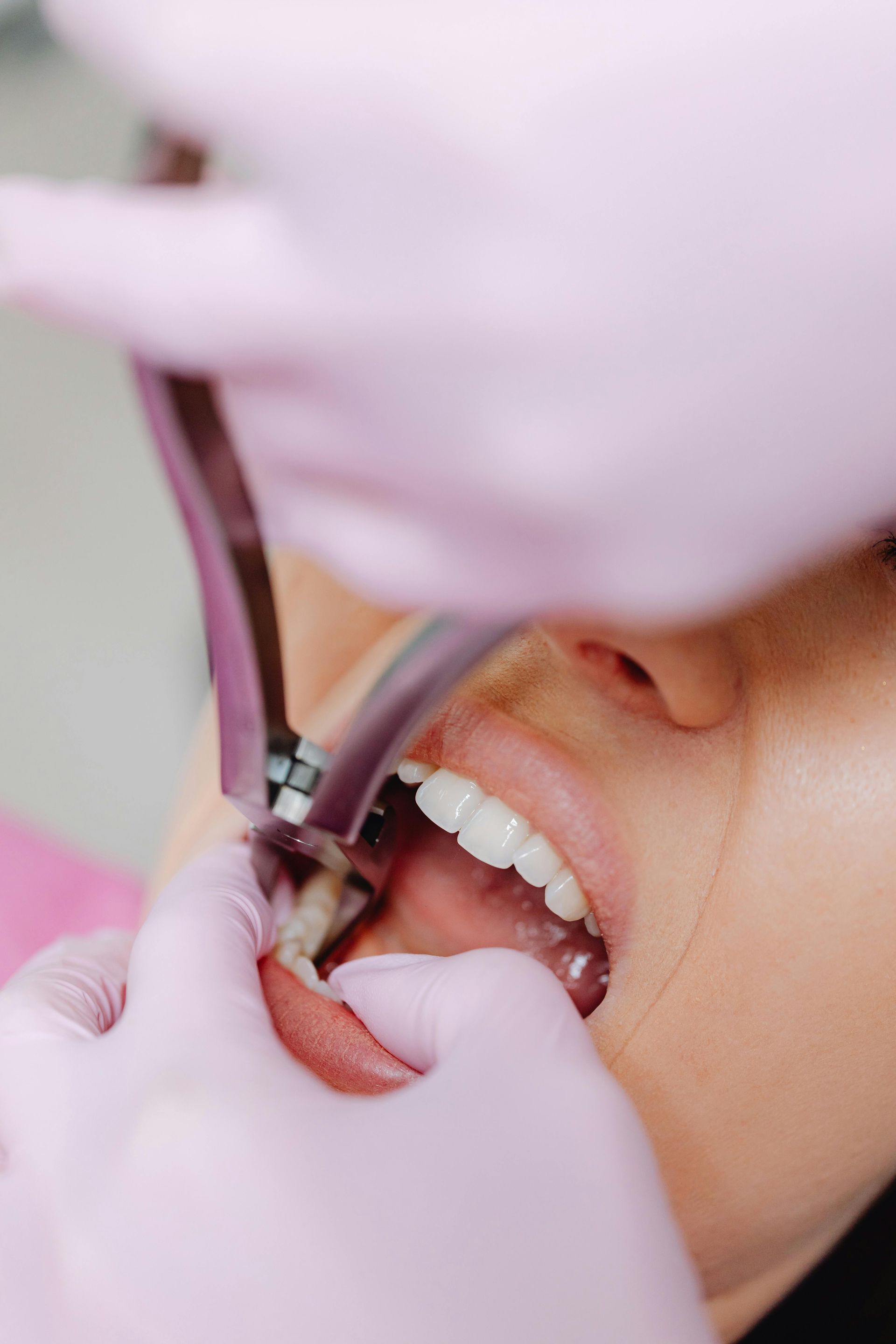 Ilustración dental en 3D que muestra un implante dental entre dientes naturales en encía rosada.