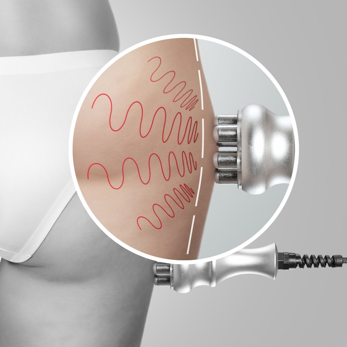 Dispositif de radiofréquence appliqué sur la peau.