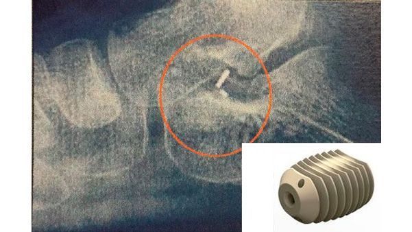 Radiografía que muestra un pequeño implante en el hueso, rodeado por un círculo, además de un pequeño implante insertado con forma de tornillo.