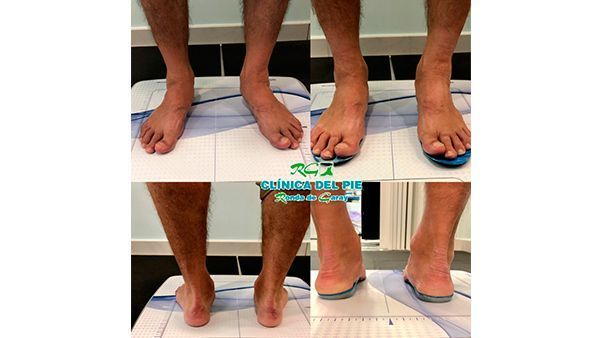 Dos fotografías de los pies de una persona de pie sobre un suelo de baldosas, vistas frontal y posterior, una al lado de la otra.