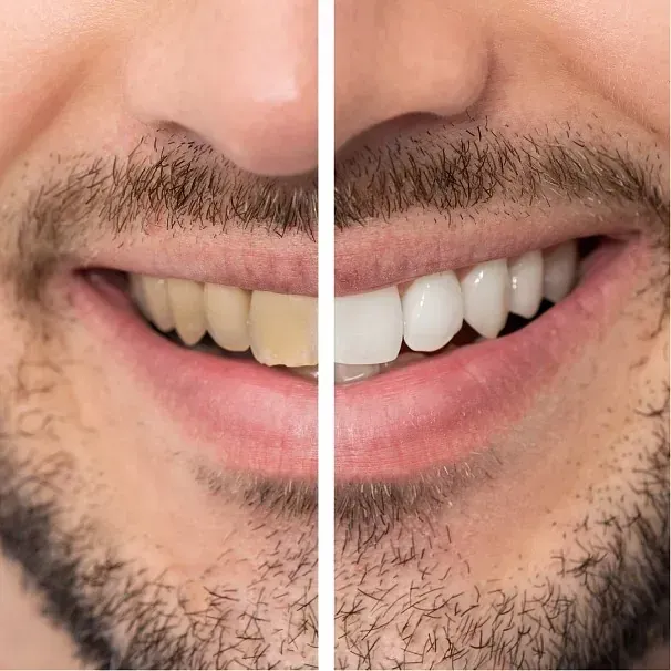Se muestra a un hombre con barba antes y después de blanquearse los dientes.