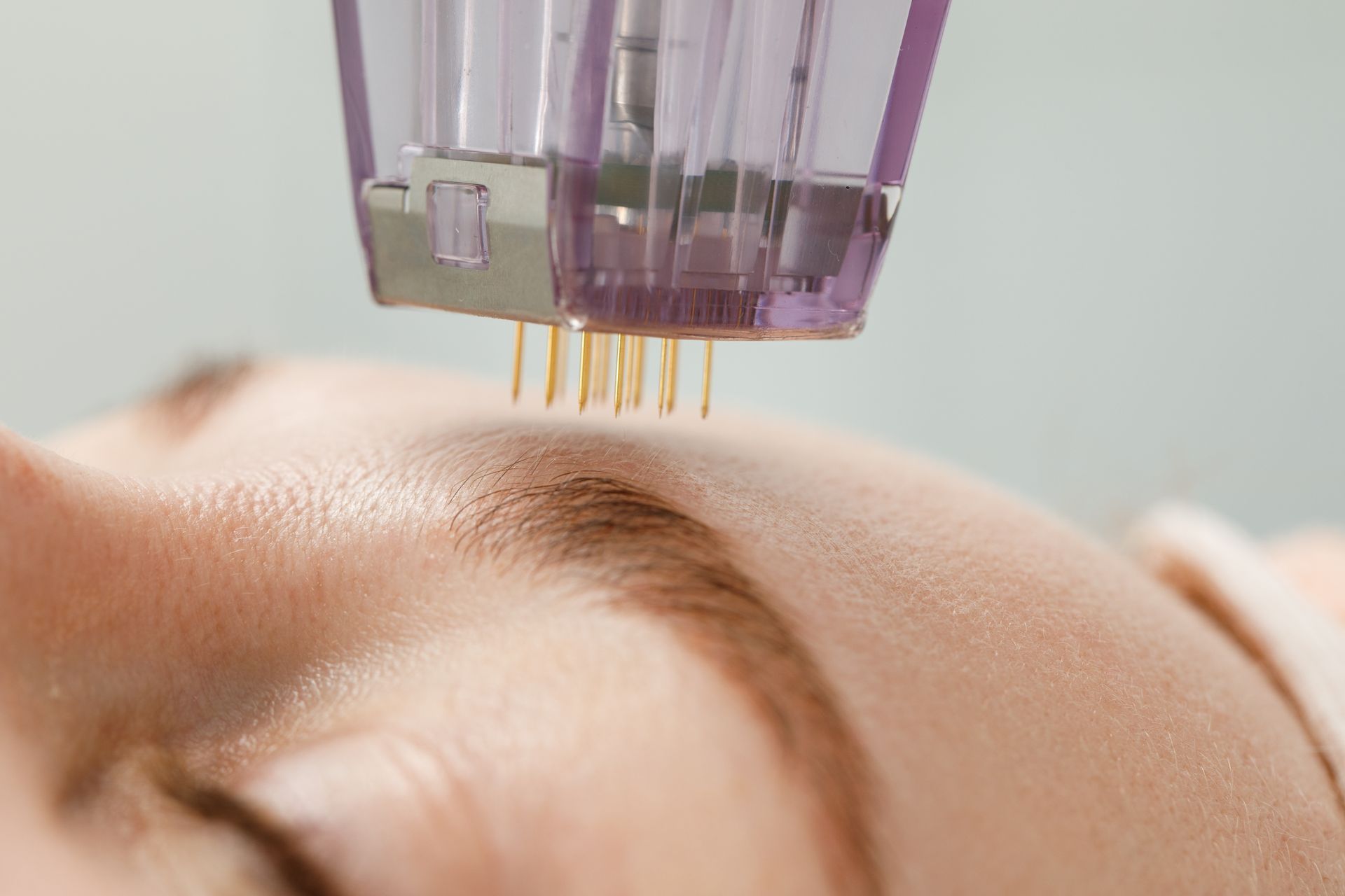 Zoom sur une séance de microneedling