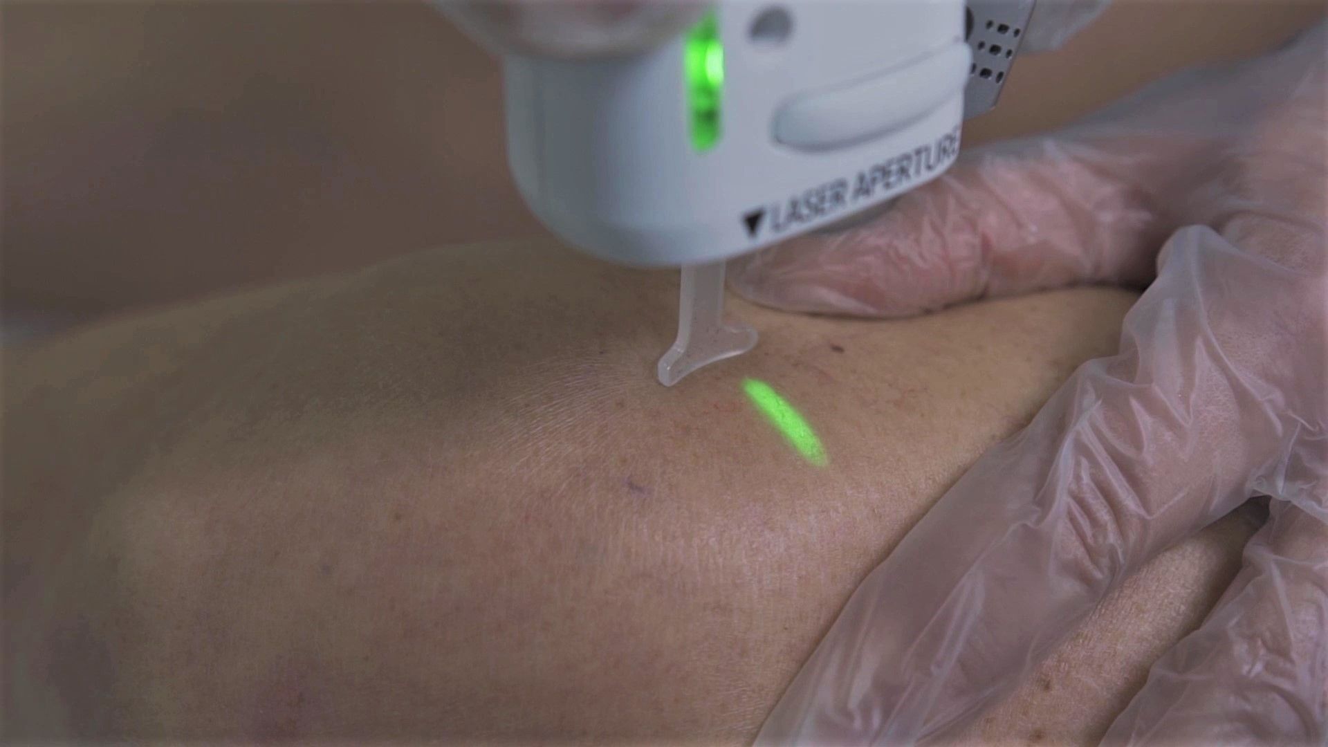 Zoom sur l'utilisation d'un laser médical