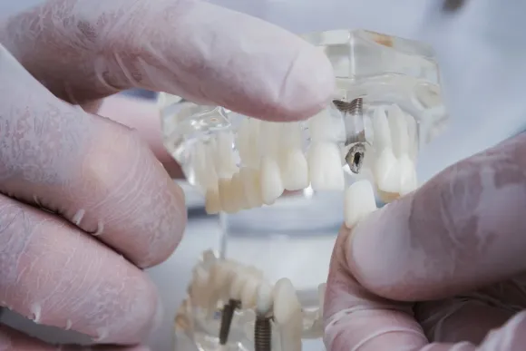 Manos enguantadas sosteniendo un modelo dental transparente con un implante y dientes.
