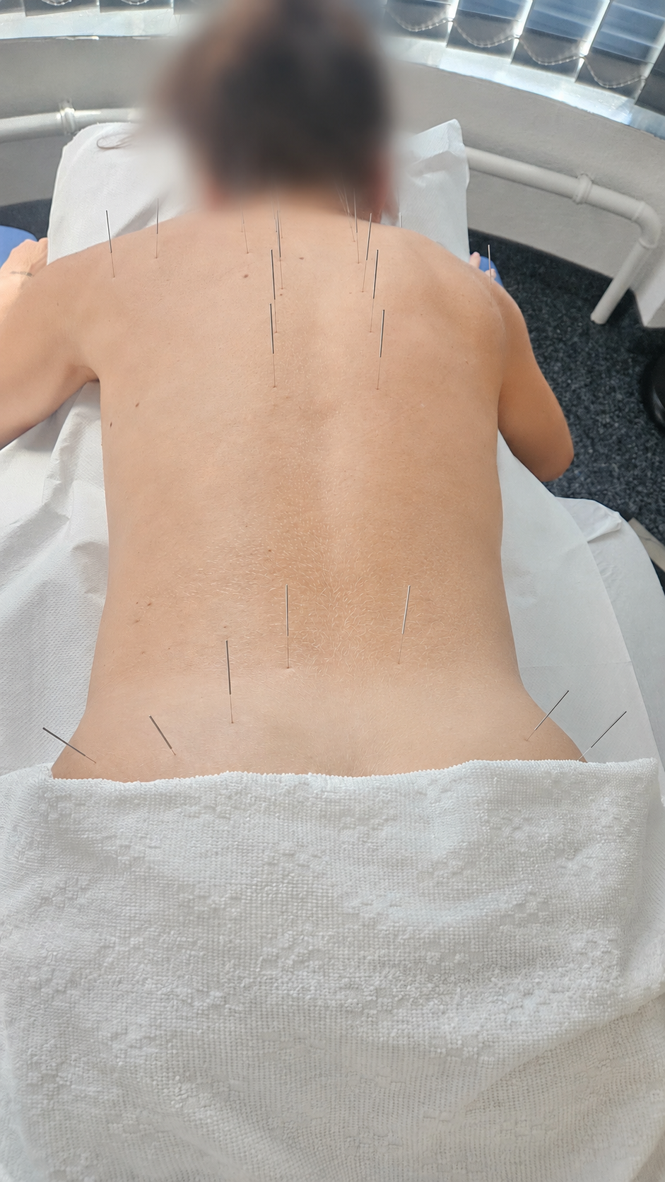 Schröpftherapie Behandlung am Rücken - traditionelle Heilmethode