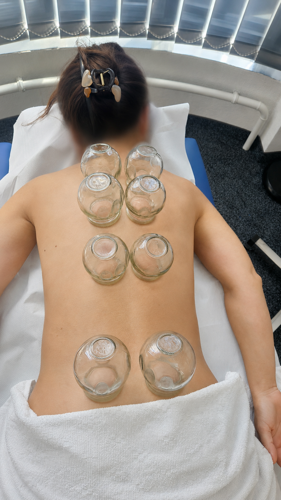 Schröpftherapie Behandlung am Rücken - traditionelle Heilmethode