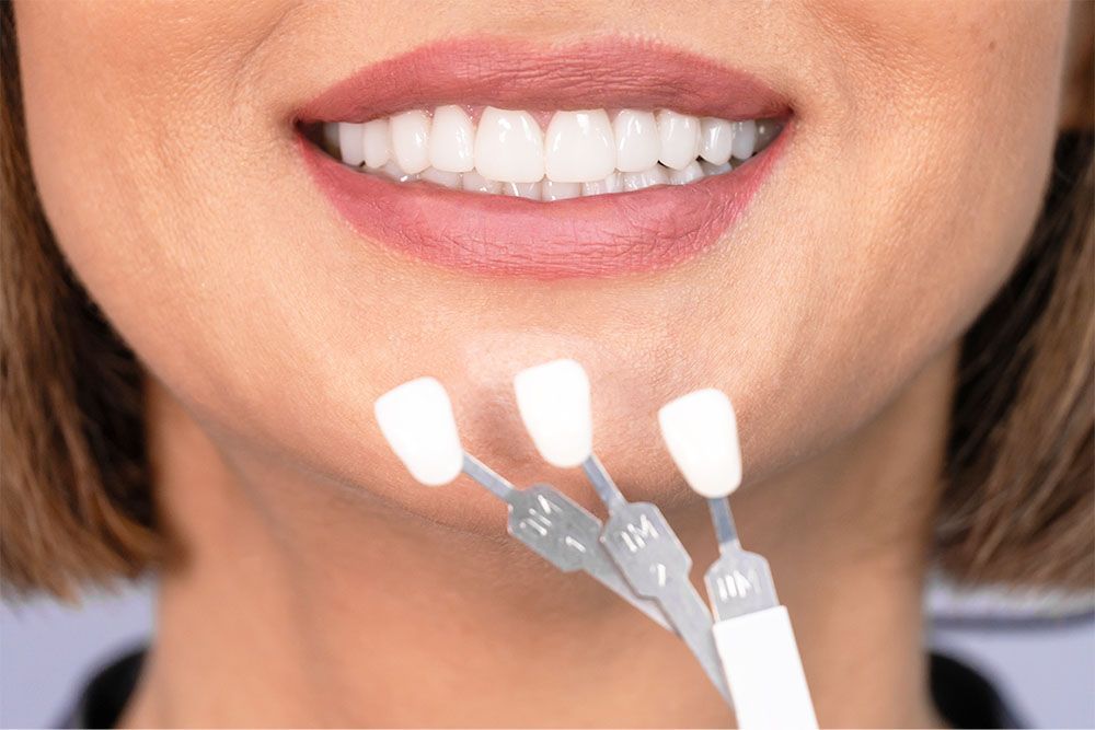 Veneers Verblendschalen verbessern das Erscheinungsbild Ihrer Zähne Veneers Verblendschalen