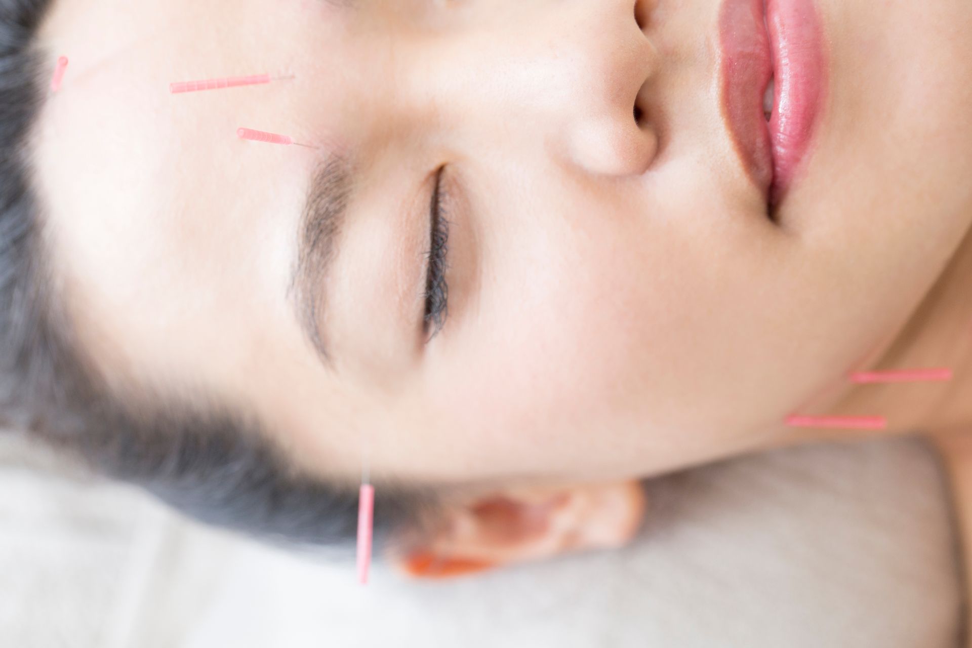 Akupunkturnadeln im Gesicht einer asiatischen Frau