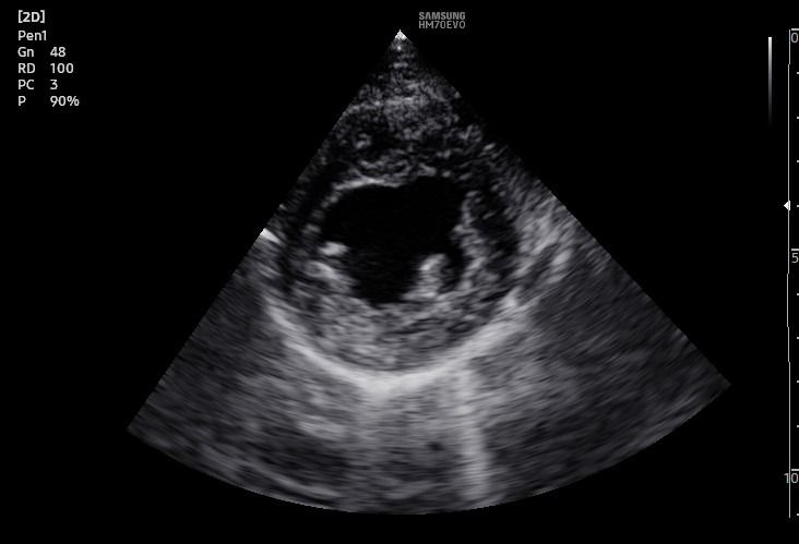 Una ecografía en blanco y negro de un corazón con un agujero en él.