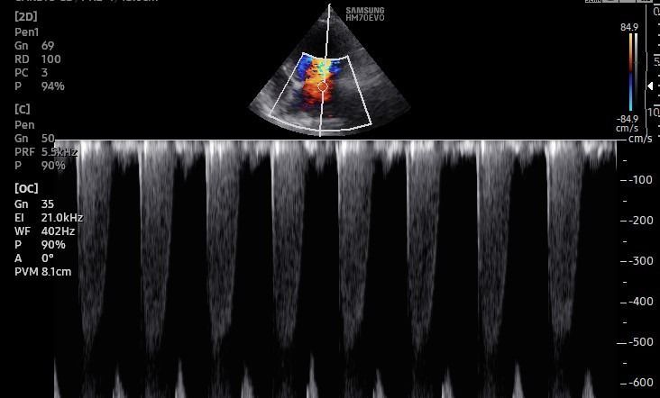 Una imagen en blanco y negro de una ecografía de un corazón.