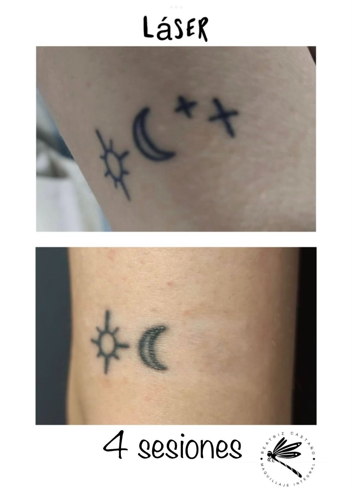 Eliminación de tatuajes