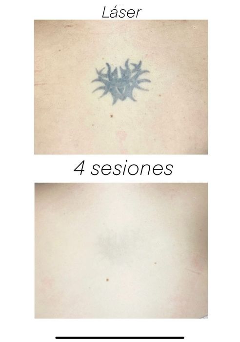 Una foto de antes y después de un tatuaje en la espalda de una persona.