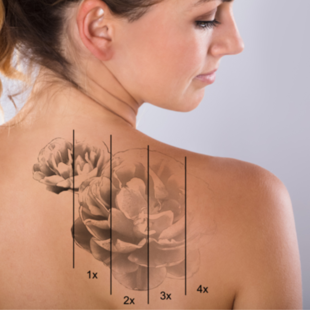 remoção tatuagens setúbal