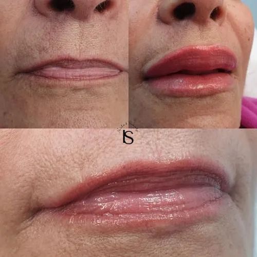 Una foto de antes y después de los labios de una mujer.