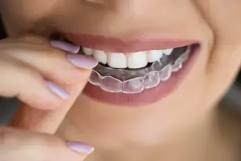 Una mujer se está colocando un aparato transparente en los dientes.