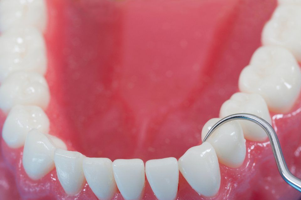 Zahnmodell mit einer zahnärztlichen Sonde zur Untersuchung eines Zahnes.