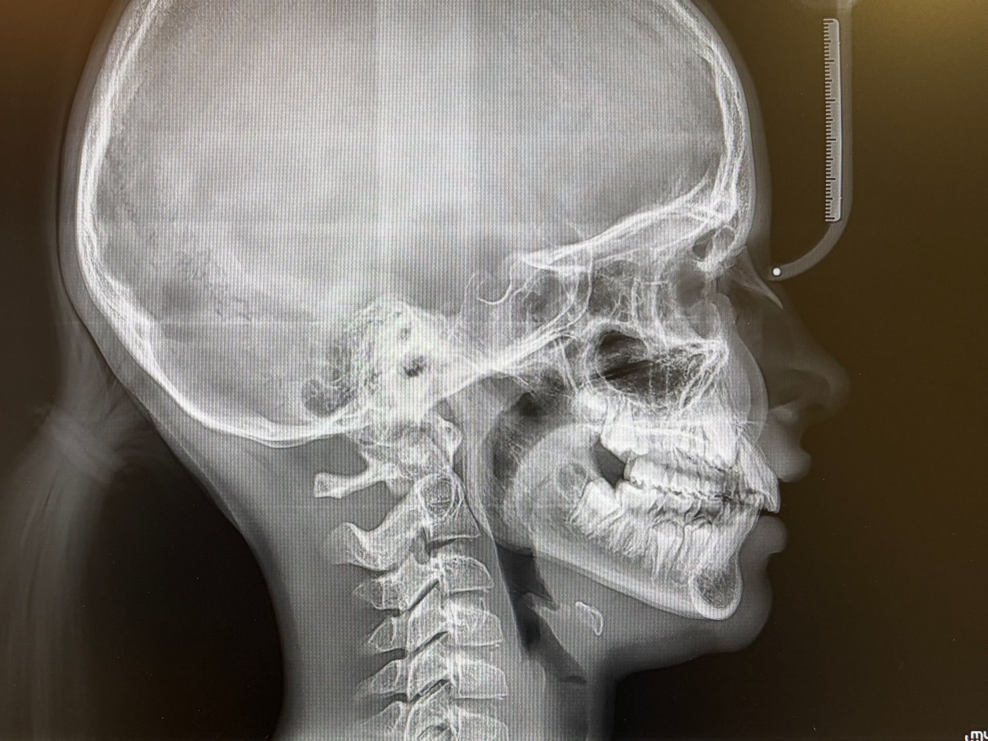 Radiografia laterale di un cranio e di un collo umano che mostra la mandibola, i denti e la colonna cervicale.