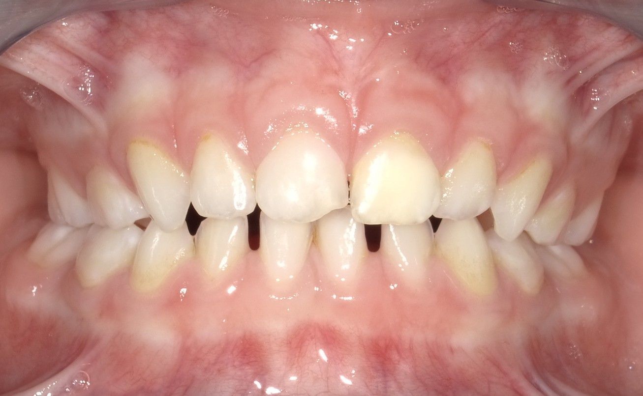 Primo piano della bocca di una persona che mostra i denti con un evidente spazio tra gli incisivi superiori.