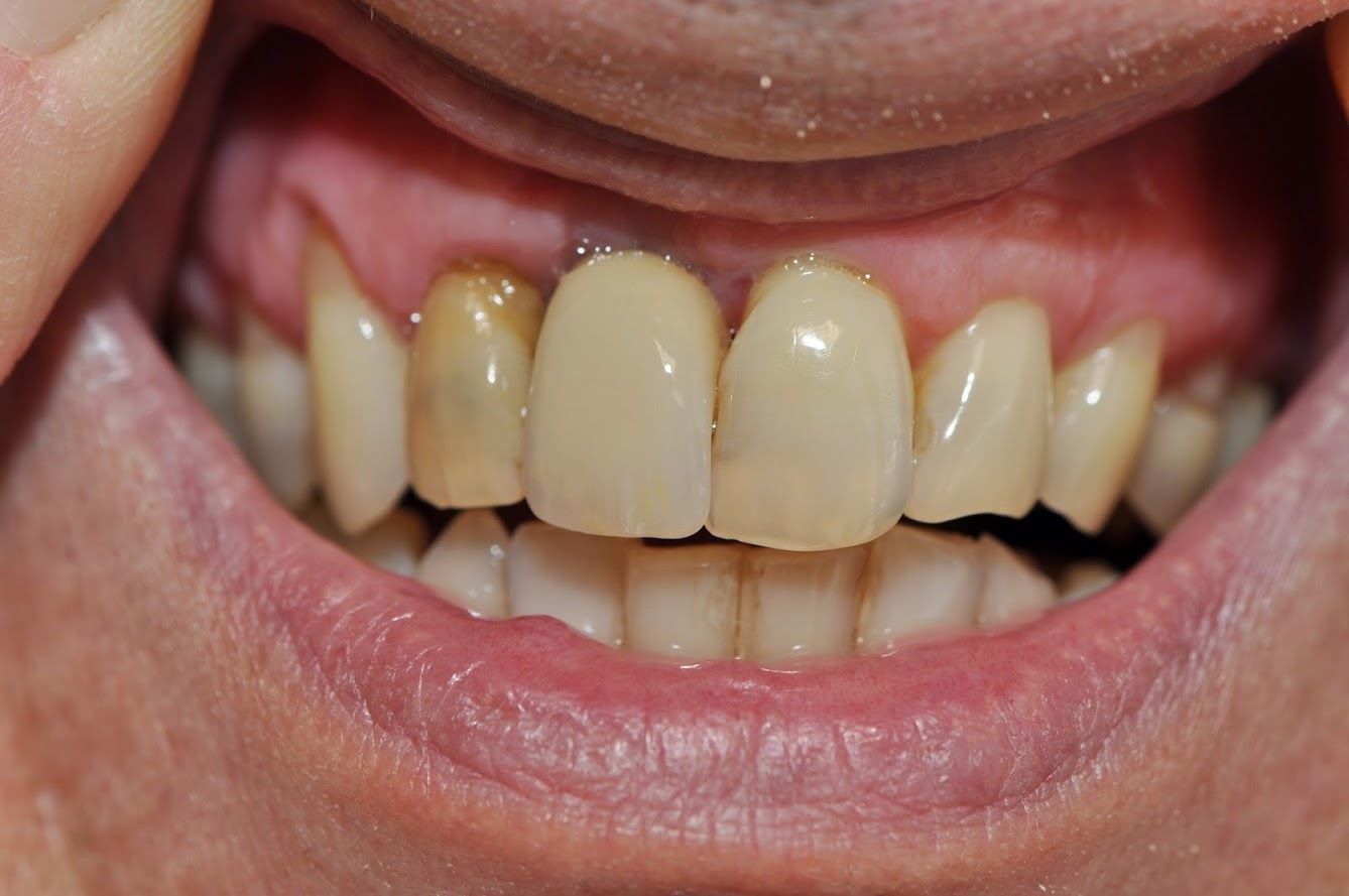Zähne 4 - Hugi Dental