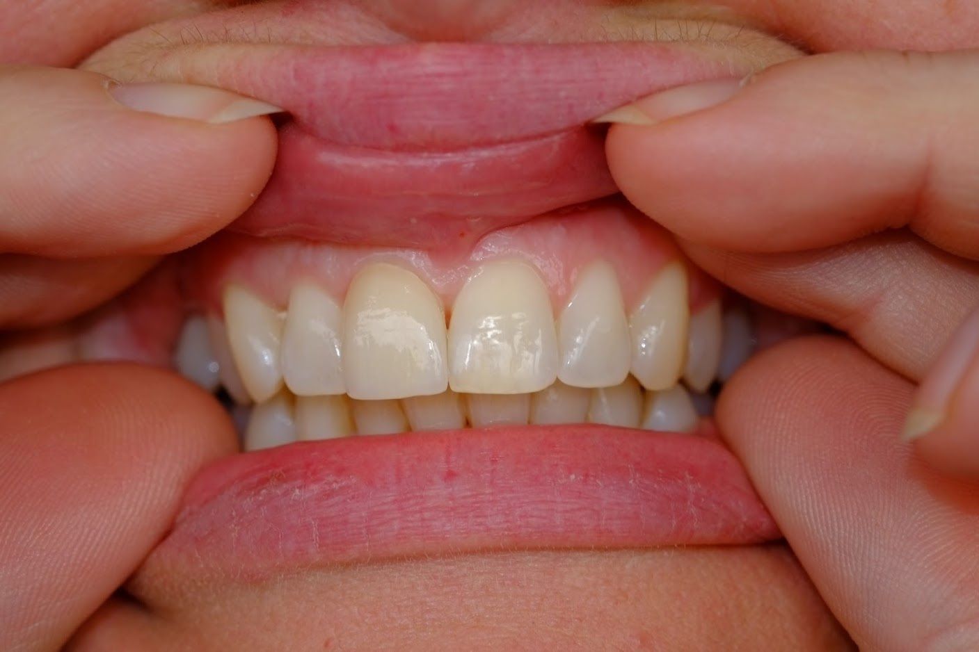 Zähne 2 - Hugi Dental