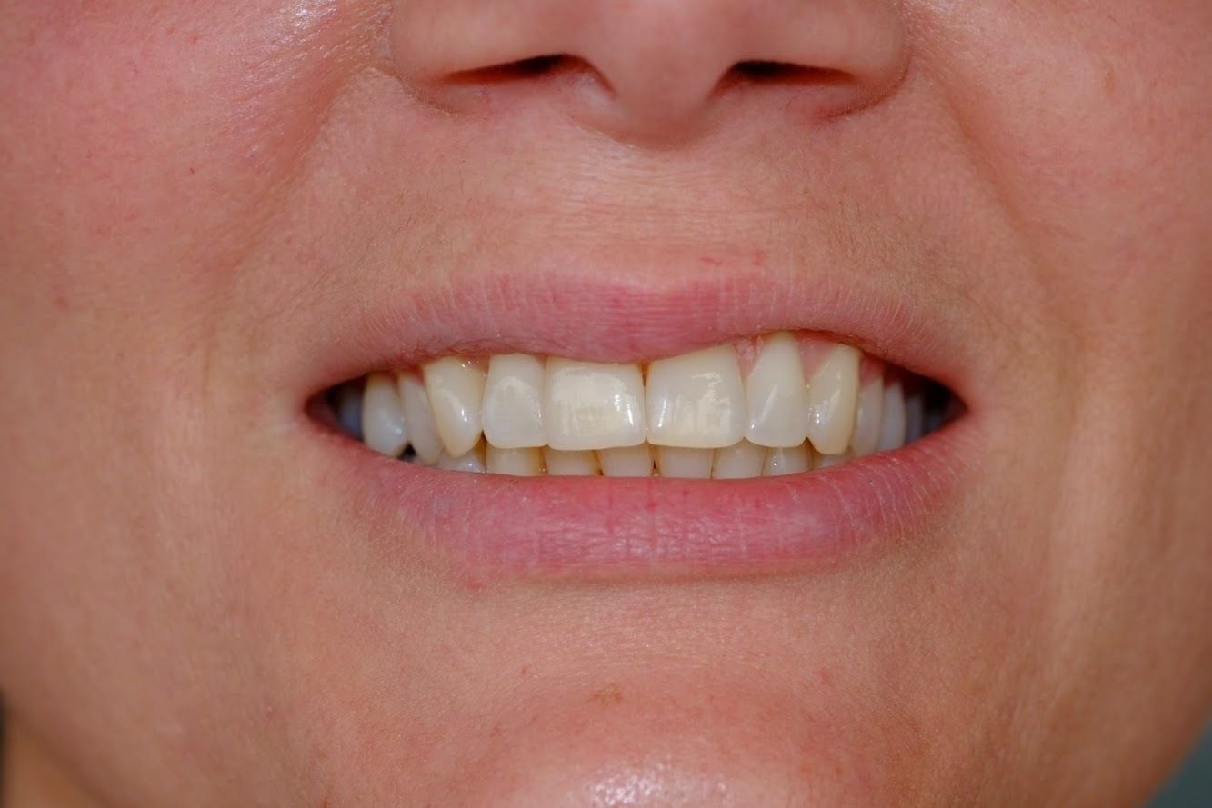 Zähne 1 - Hugi Dental