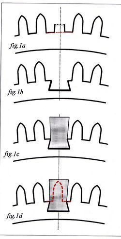 Remplacement d'une dent cassée - Chez l'Horloger