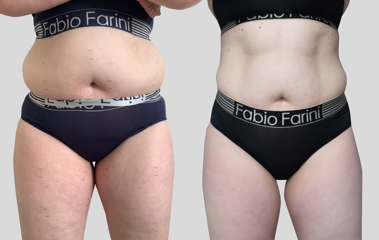 Vorher-Nachher-Bild einer Frau