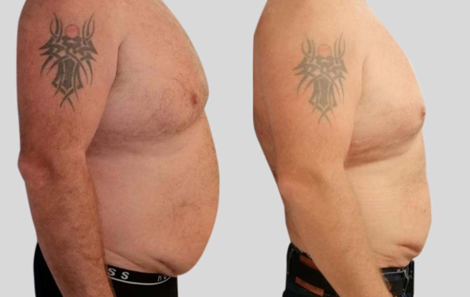 Ein Vorher-Nachher-Bild eines Mannes mit einem Tattoo auf dem Arm