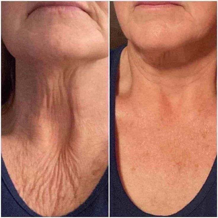 Una persona está acostada sobre una manta azul con tubos adheridos a ella.