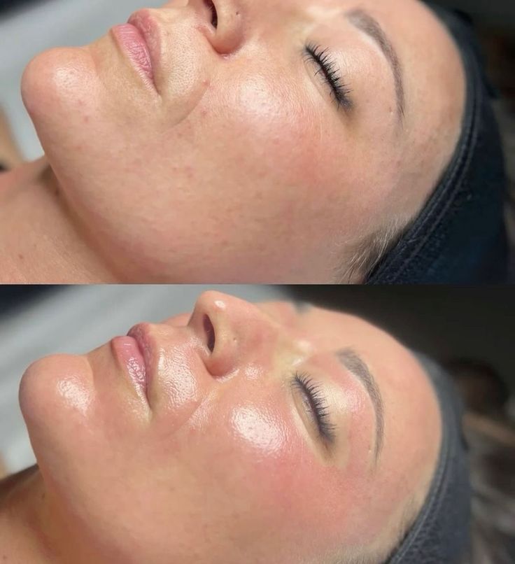 Una mujer está recibiendo un tratamiento de peeling al estilo Hollywood.