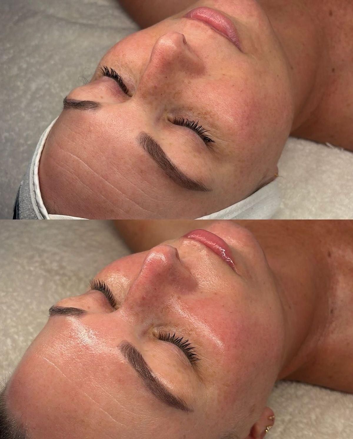 Una mujer está acostada en una cama recibiendo un tratamiento facial.