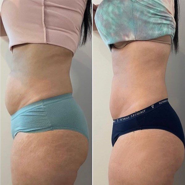 Una mujer está recibiendo un masaje con un palo de madera.