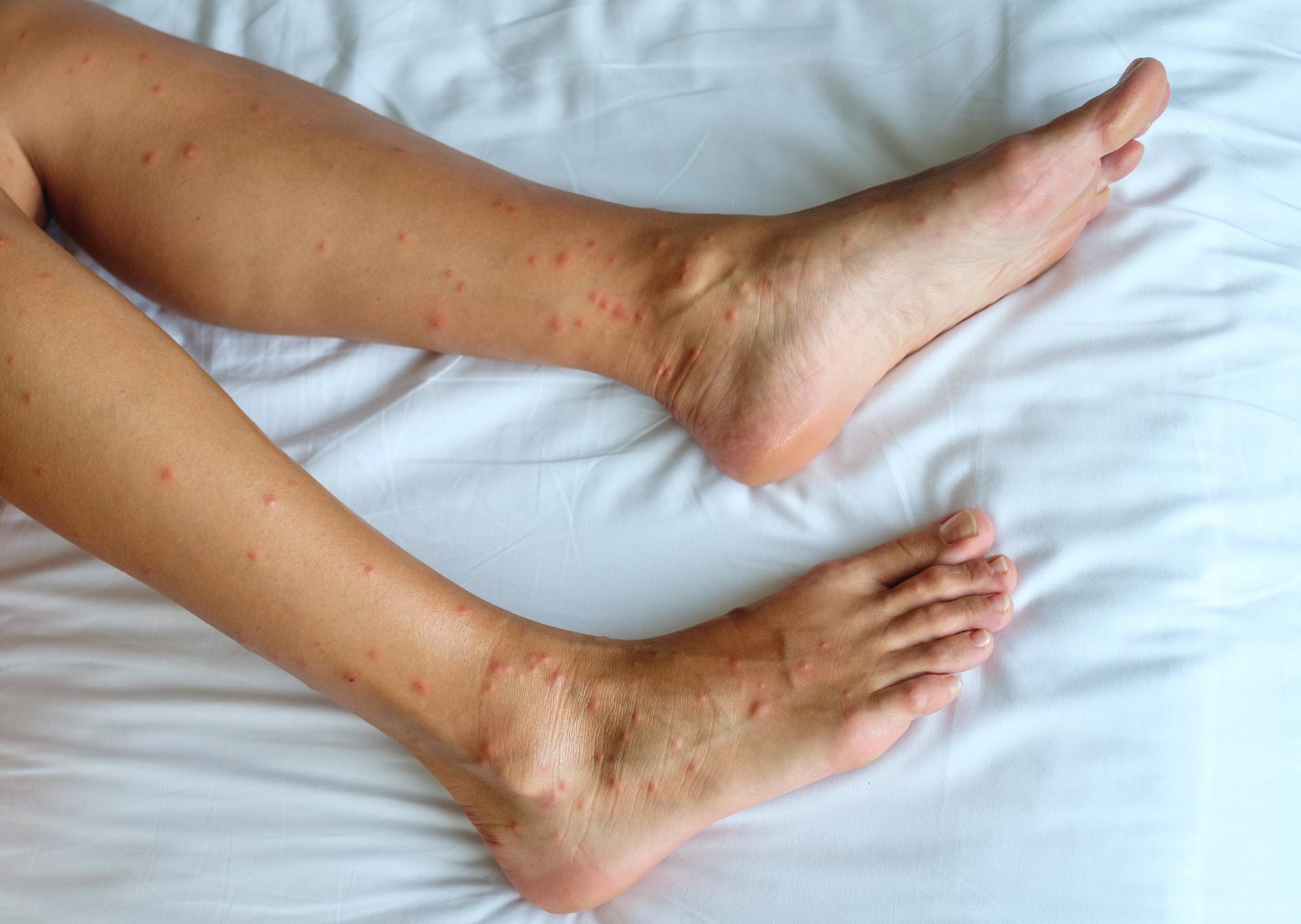 Les jambes d'une personne avec des piqûres de punaises de lit