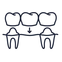 Un dibujo lineal de un puente dental entre dos dientes.