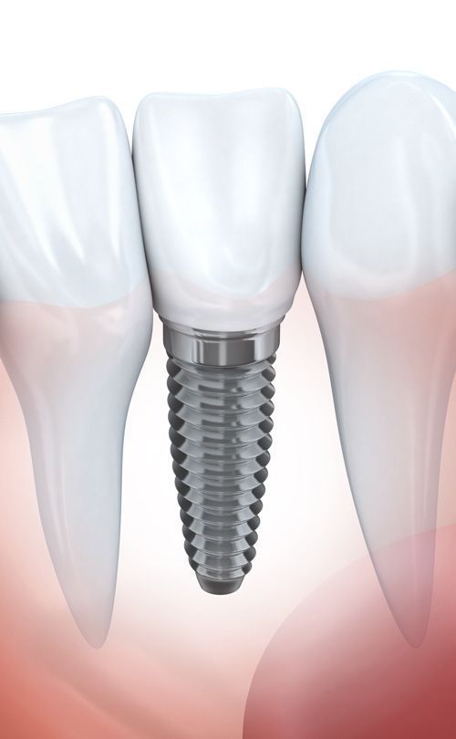 Un primer plano de un implante dental entre dos dientes.