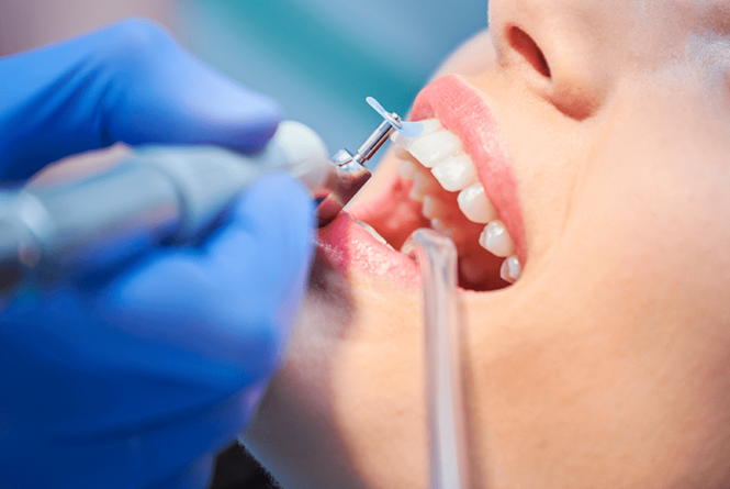 Dentista colocando aparatos de ortodoncia a un paciente con guantes azules y un separador de mejillas.