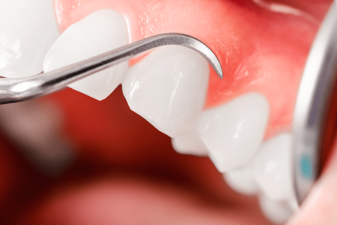 Instrumentos dentales que examinan de cerca los dientes blancos y las encías rosadas de un paciente.