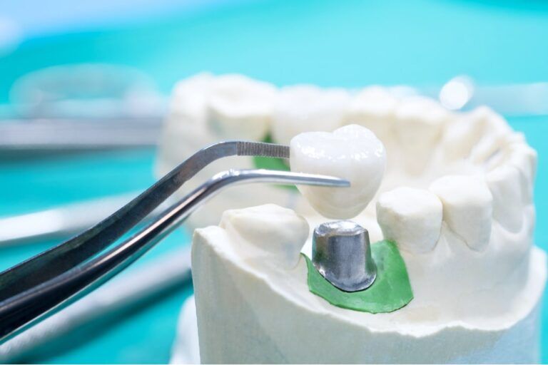 Dentista realizando un tratamiento con coronas dentales