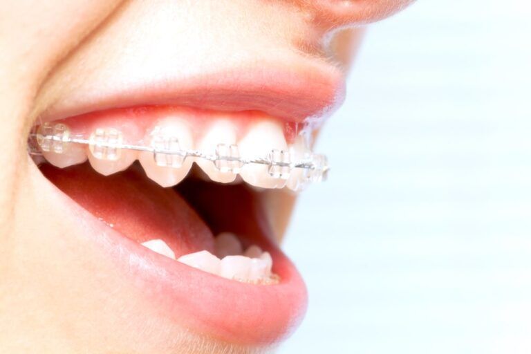 Tratamiento de ortodoncia invisible con alineadores dentales