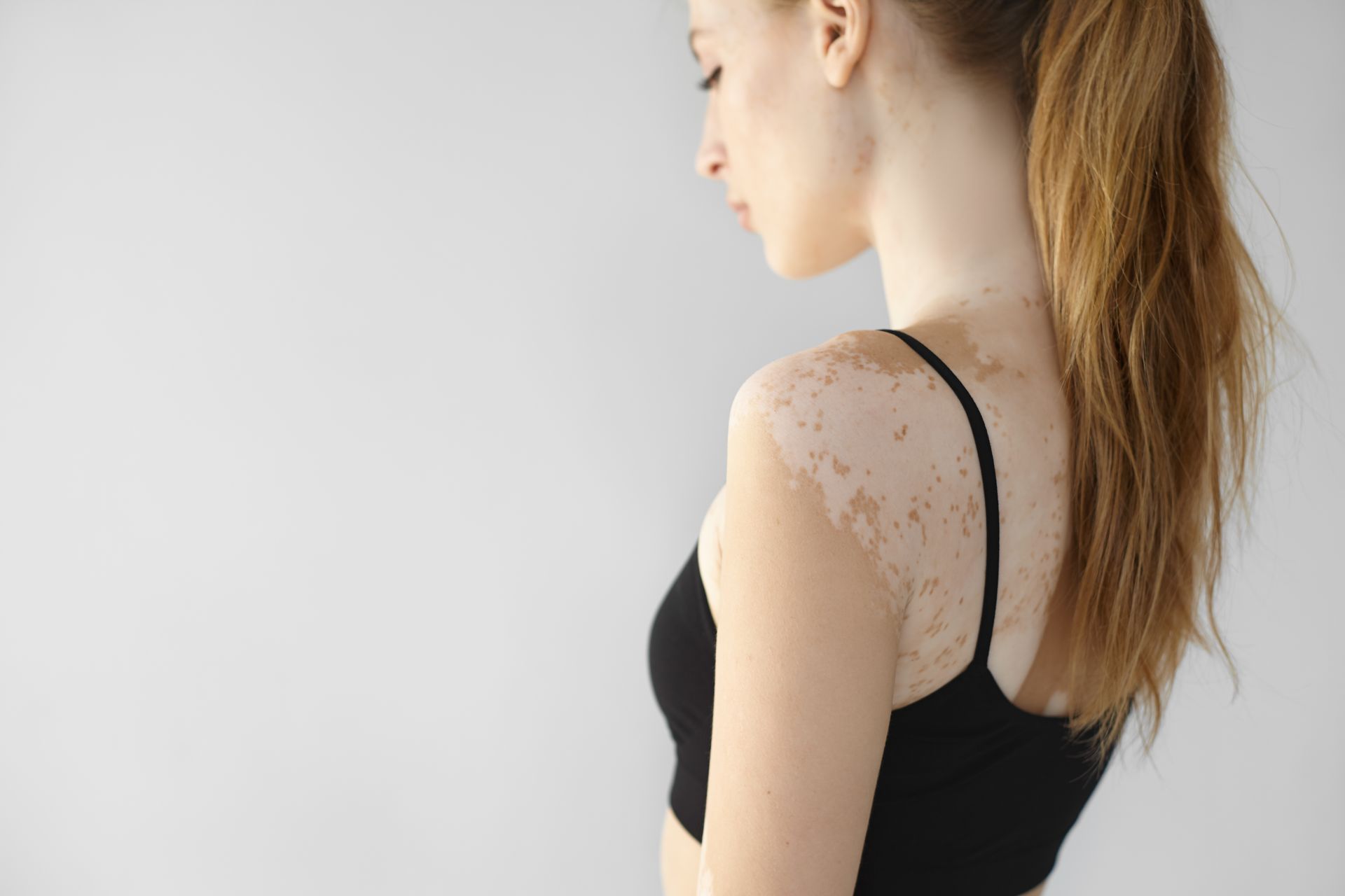 Vue de profil d'une femme ayant un vitiligo.