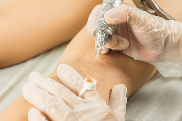 Des mains gantées appliquent la de la couleur à l'aide d'une aiguille de tatouage sur la peau du patient.