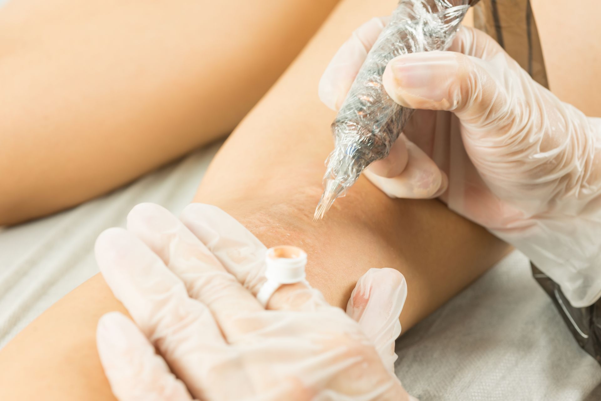 Des mains gantées pratiquent une injection cosmétique sur le bras d'une personne à l'aide d'une seringue.