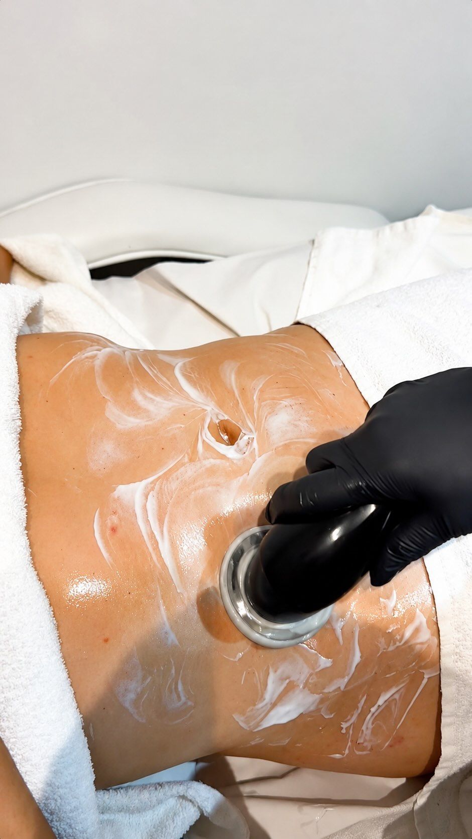 Mano enguantada aplicando crema blanca en el abdomen de una persona en un entorno clínico.