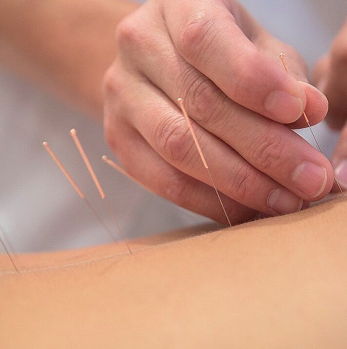 Una persona está recibiendo acupuntura en la espalda.