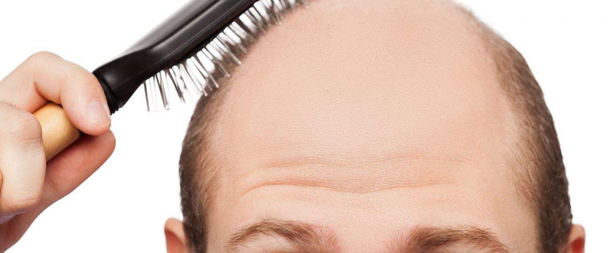 Hilfe, Haarausfall! Behandlung mit Plantur 39 und Lasertherapie