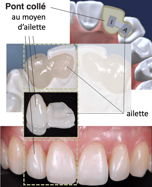 Pont collé - Cabinet médicaux dentaire Places St- François