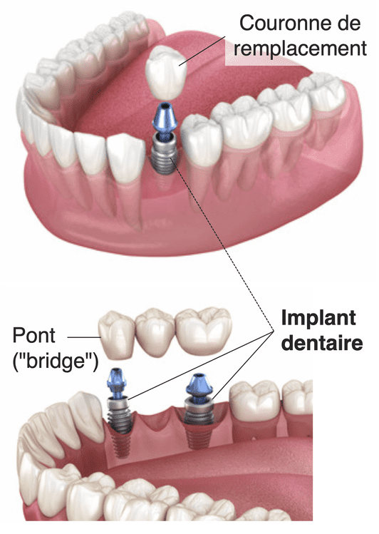 Implant dentaire - Cabinet médicaux dentaire Places St- François