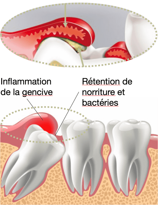 Extraction dents de sagesse - Cabinet médicaux dentaire Places St- François